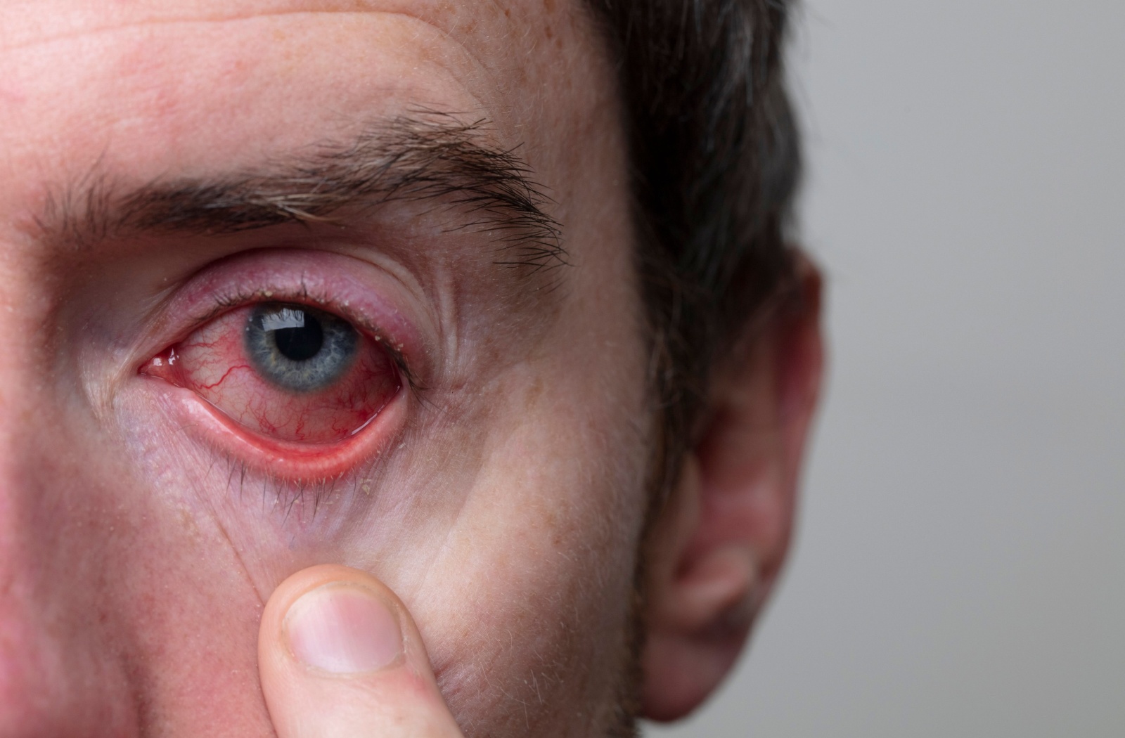 Close-up of a severely bloodshot eye, often mistaken for pink eye.