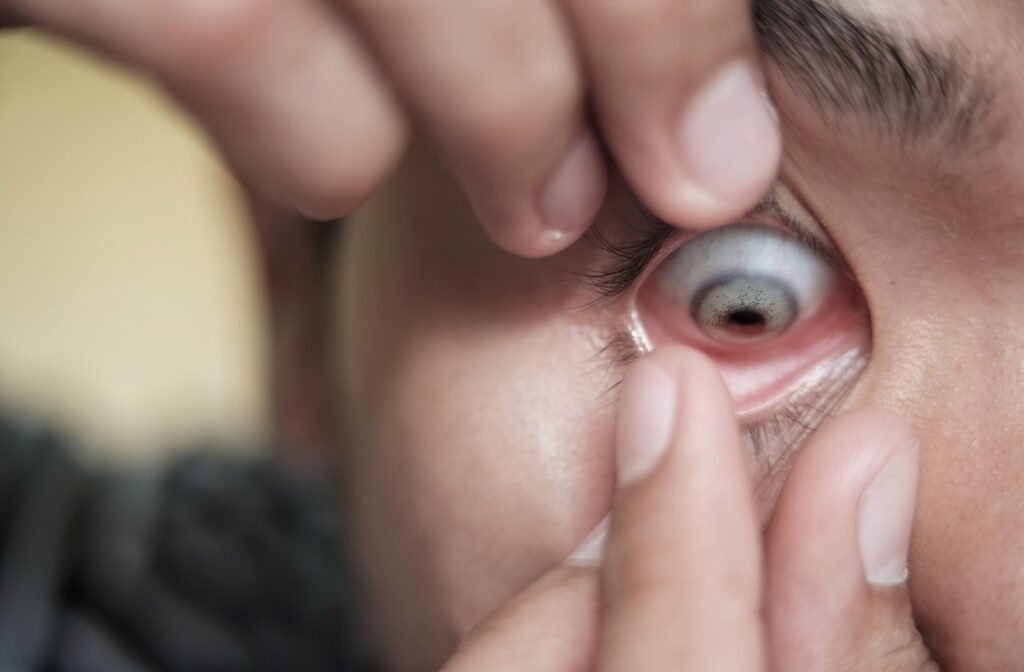 A close-up image of someone removing a soft contact lens from their eye.