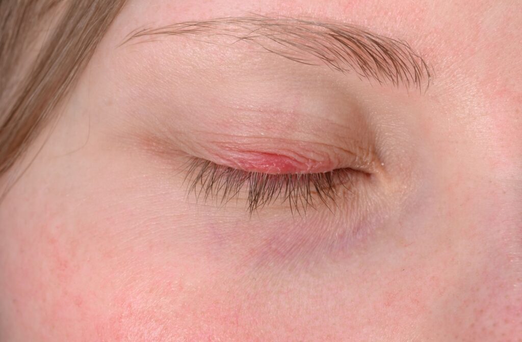 A close up of an eye that has a stye on it